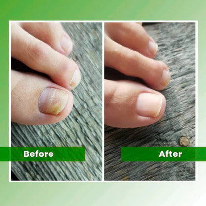 Fungiclear- Nail Fungus Laser