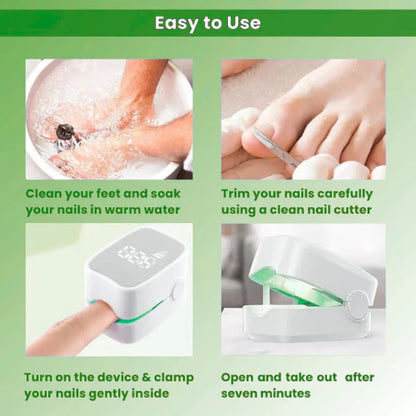 Fungiclear- Nail Fungus Laser