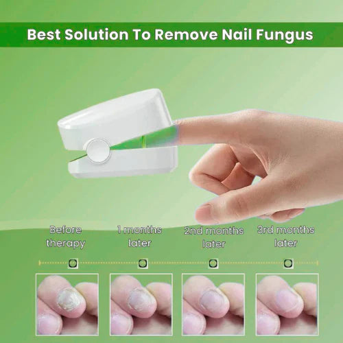 Fungiclear- Nail Fungus Laser