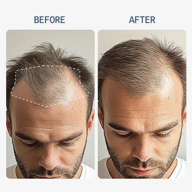 Stem Cell Hair Restoration