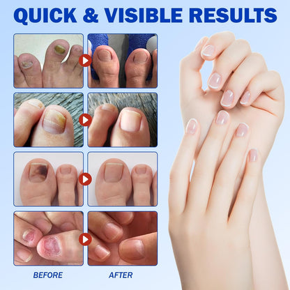 Fungal Nail Patches